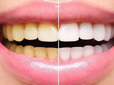 TEETH WHITENING